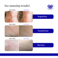 thumbnail image 6 of Rejuvaskin Rejuvasil Silicone Scar Gel – Scar Treatment for Surgical Scars for Face, Body, Burn, Keloids, and Acne Scar  – Silicone Gel for Scars to Reduced the Appearance of Old & New Scar -30ml, 6 of 8