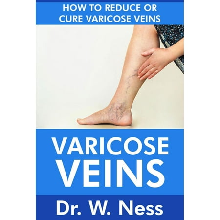 Varicose Veins: How To Reduce Or Cure Varicose Veins - (Best Way To Cure Varicose Veins)