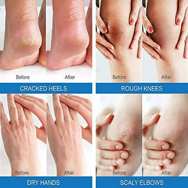 Urea 40% Foot Cream For Cracked Heels And Dry Skin,Cracked Heel Repair –  TweezerCo