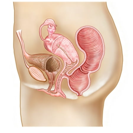 Rectovaginal fistula and cross section of female reproductive organs Canvas Art - Stocktrek Images (27 x (Best Way To Treat Fistula At Home)