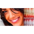 thumbnail image 4 of Expertwhite Extreme 44% Teeth Whitening Gel (6-gels) Free Shipping, 4 of 5