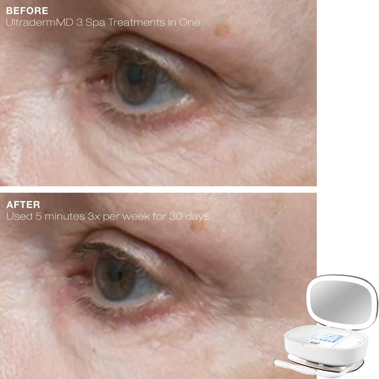 【未開封】美顔器 Trophy Skin MicrodermMD Amazon.com: Trophy Skin MicrodermMD at Home