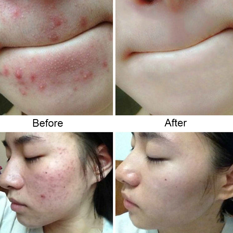 Buy 2 Pack Acne Treatment Soap Relief from Mites, Fungus, Dermatitis