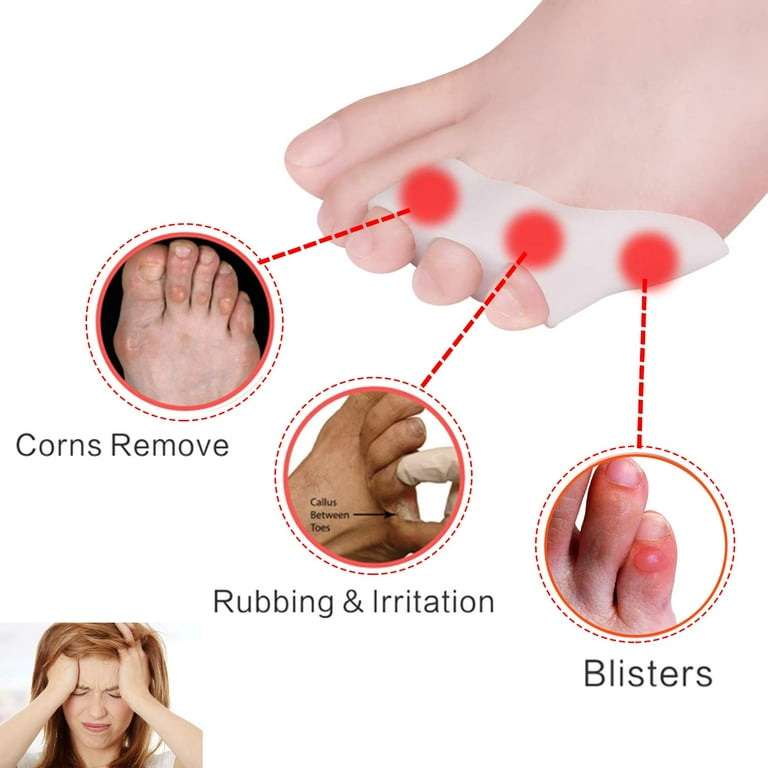 Pinky Toe Bunion Removal