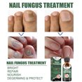 thumbnail image 1 of Tratamiento de hongos en las uñas Tratamiento de hongos en las uñas Líquido reparador de uñas Fácil de usar Ndcxsfigh  Cuidado Belleza, 1 of 4
