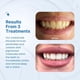 thumbnail image 3 of PurelyWHITE DELUXE Kit de blanqueamiento dental Blanqueamiento dental completo con LED Más de 15 tratamientos (3) Jeringas de gel blanqueador de 3 ml Sonrisa más blanca en 7 minutos, 3 of 7