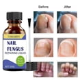 thumbnail image 1 of Fungal Nail Treatment - 30ml Extra Strong Nail Fungus Treatment for Toenail - Anti Fungus Nail Repair and Strengthen, 1 of 5