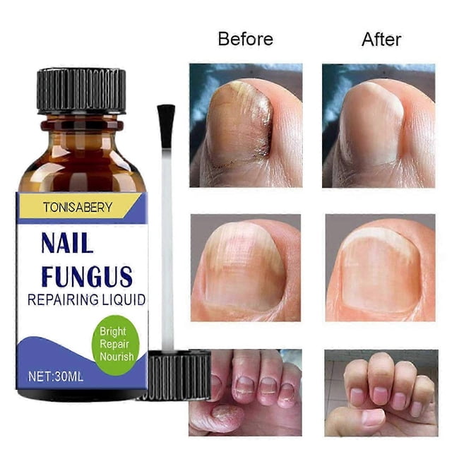 Fungal Nail Treatment - 30ml Extra Strong Nail Fungus Treatment for Toenail - Anti Fungus Nail Repair and Strengthen
