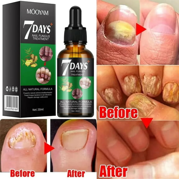 Mooyam Multi-Purpose Nail Repair Serum, Nail Solution for Discolored and Damaged Nails, 1 fl oz