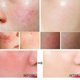 thumbnail image 2 of Crema reparadora de rojeces faciales, hidratante que mejora la sequedad de la piel sensible, loción hidratante de pata de gallo, eliminación de Rosacea, Cosméticos Coreanos, 2 of 5