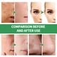 thumbnail image 4 of Mascarilla facial con burbujas Acnre Centella Asiatica Remove Black Oil, 4 of 7