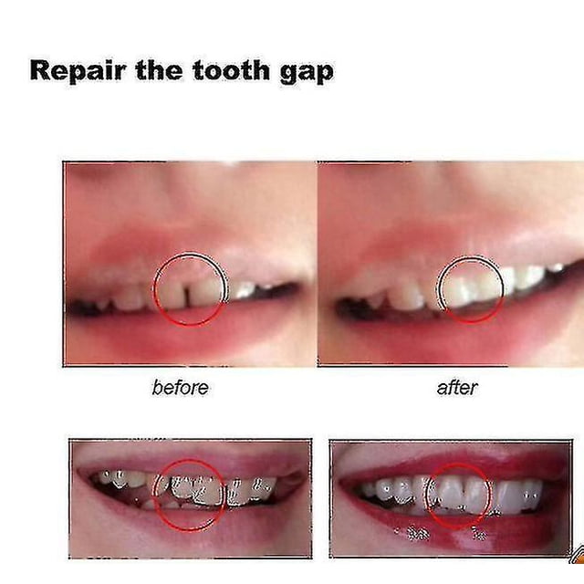 100 g de pegamento sólido para dientes y espacios entre dientes, adhesivo de resina para dentaduras postizas, adhesivo sólido para dientes de dentista, pegamento temporal para dientes postiz