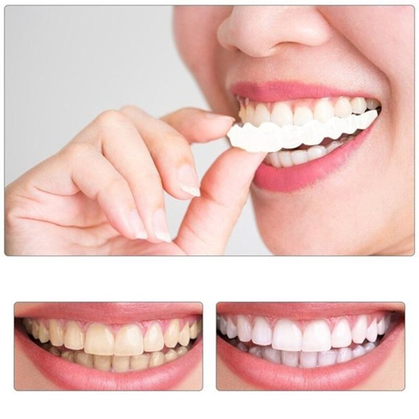 4 Paires Facettes Dentaires Provisoires - Blanchiment - Kit Complet - Neuf