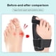 thumbnail image 5 of Corrector Juanete Herramienta Ajustable para El Cuidado Los Pies Alisador Del Dedo Pie, 5 of 9