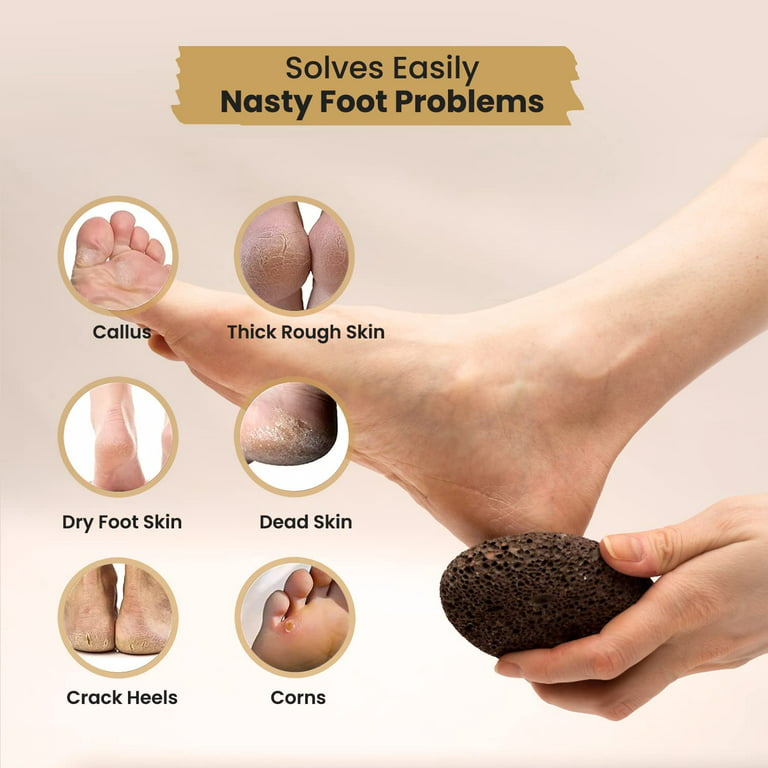 Vridale Pumice Stones for Feet Lava Pumice Stone Foot File Callus Removal Foot Scrubber for Hands Care Foot Exfoliation Dead Skin Remover with Handle