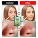 thumbnail image 5 of Mascarilla de arcilla de té verde Ndcxsfigh Cuidado Belleza tratamiento del acné facial Eliminador de espinillas, 5 of 8