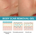 Silicone Scar Gel, Helps Improve Size, Color & Texture of Hypertrophic & Keloid Scars on Face