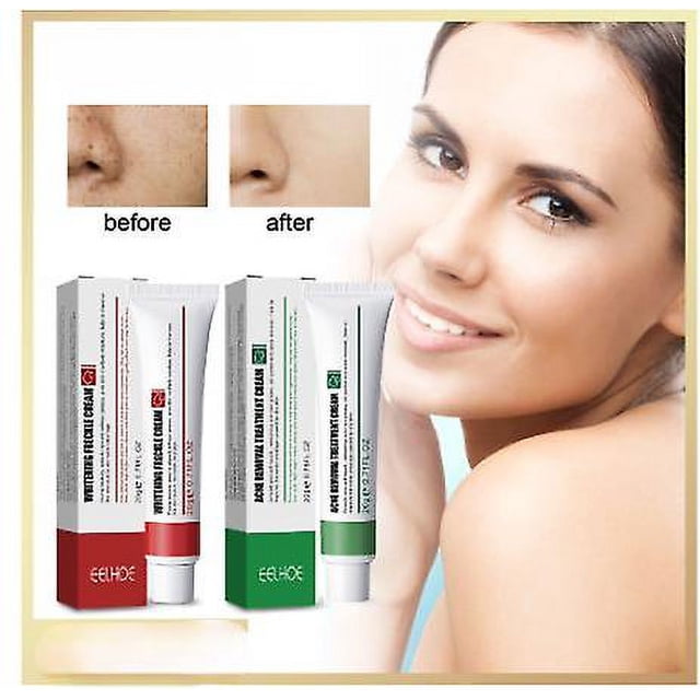 Crema para eliminar acné y manchas/manchas aclaradoras y piel brillante/crema hidratante para el cuidado de la piel manchas y manchas de acné