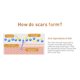 thumbnail image 2 of 30g Scar Gel Acne Scar Removal Cream For Removing Old Scars Burns, Cuts And Stretch Marks On Face And Body ANGGREK Scar Gel, 2 of 8