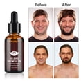 thumbnail image 5 of Beard Growth Oil Comb And Bag(black) 5pcs Beard Growth Kit With Derma Roller, 5 of 5