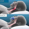 thumbnail image 4 of Honex Anti Snoring Mouthpiece The Quiet Soothie Snoring Mouth Guard Sleep Apnea Aid for Men and Women, 4 of 5