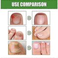 thumbnail image 2 of 3x Nail Shield Anti-fungal Stick Nailshield Anti Fungal Stick,monsalife Nail Shield Anti Fungal Stick, 2 of 5