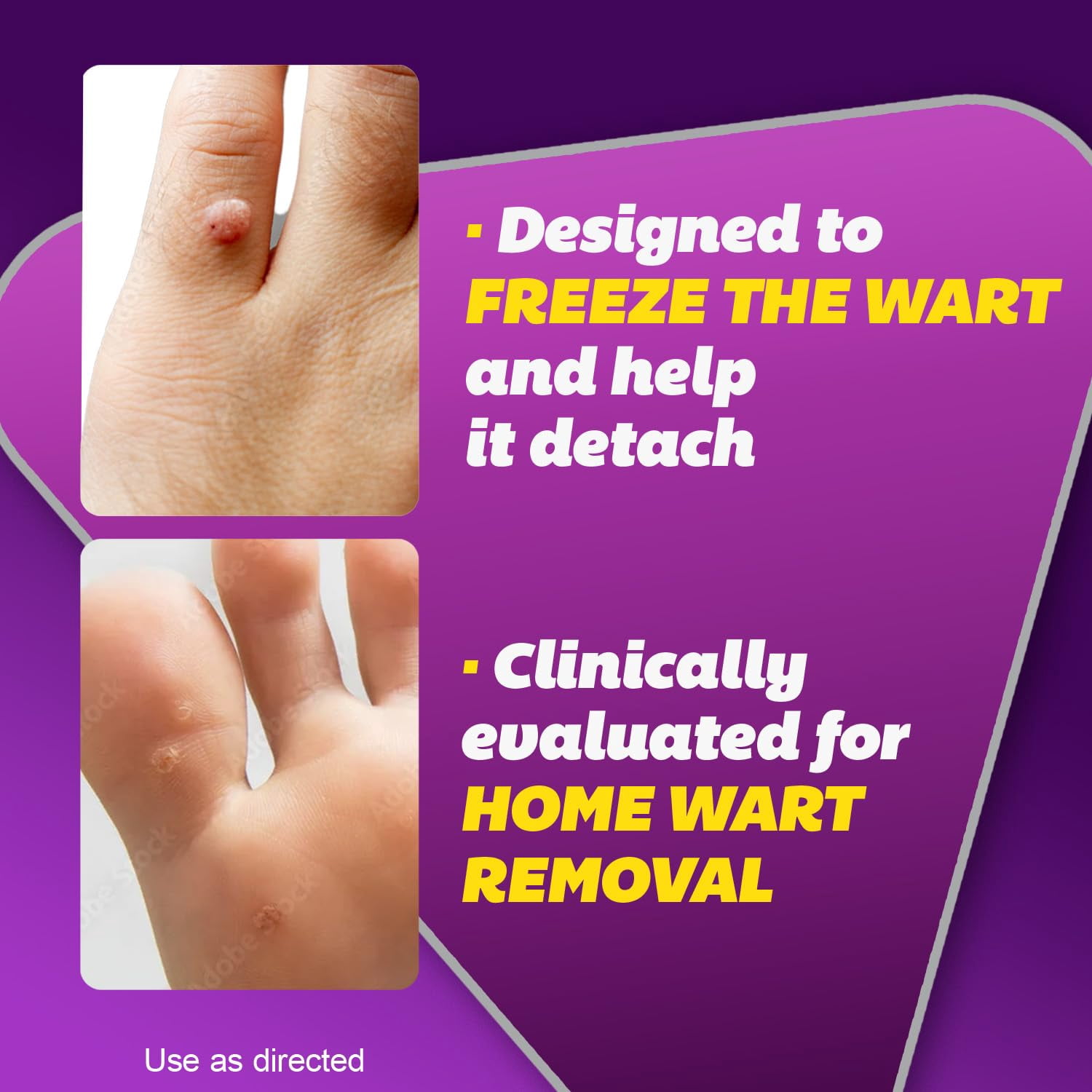 Silka Pointts Freeze Off Wart Remover for Common & Plantar Warts, 12 Applicators, Pack of 2