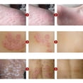 thumbnail image 4 of Crema De Medicina China Para Psoriasis, Dermatitis, Eccema, Prurito, Problemas De La Piel, Alivia La Picazón De La Piel, Ungüento, 4 of 5