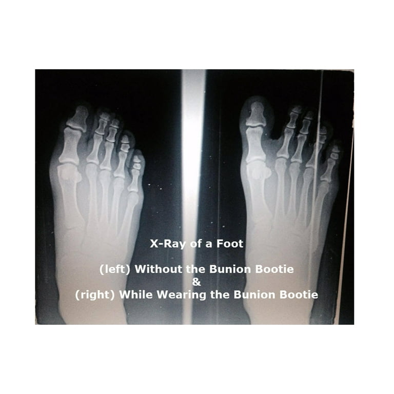 Bunion bootie before and deals after