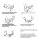 thumbnail image 4 of Inguinal Hernia Belt For Men Left Or Right Side Post Surgery Inguinal Hernia Support Truss S20241230, 4 of 4