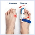 thumbnail image 3 of Lishi Adjustable Valgus Corrector for Big Toe Joint - Protective Cover for Men and Women, 3 of 5