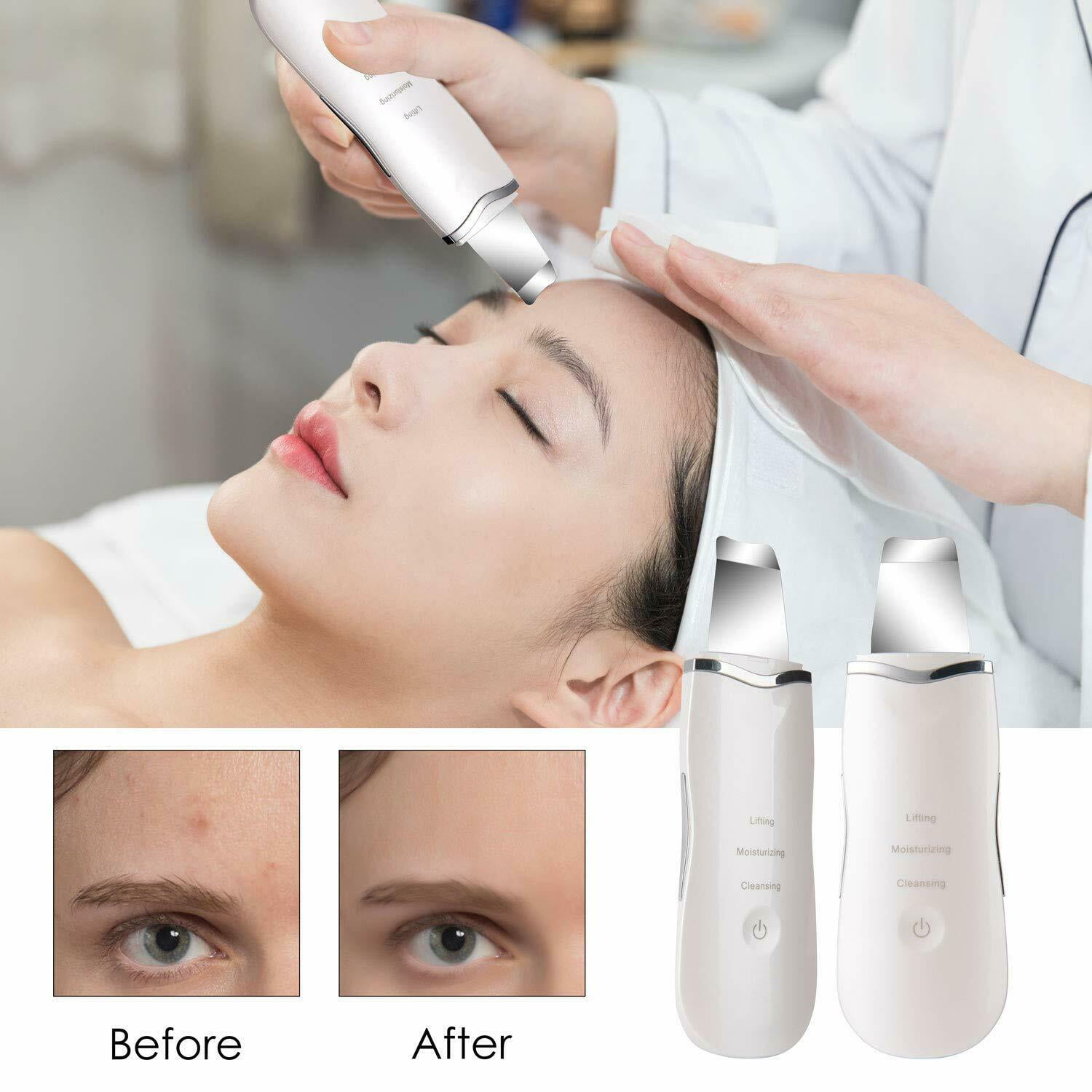 Skin Scubber,ANLAN Ultrasonic Blackhead Remover Face Cleaner,Electric –  TweezerCo
