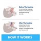 thumbnail image 5 of 2025 New Honex Anti Snoring Mouthpiece, The Quite Night Anti snoring Device, Mouth Guard for Women and Men, Soft and Comforta, 5 of 5