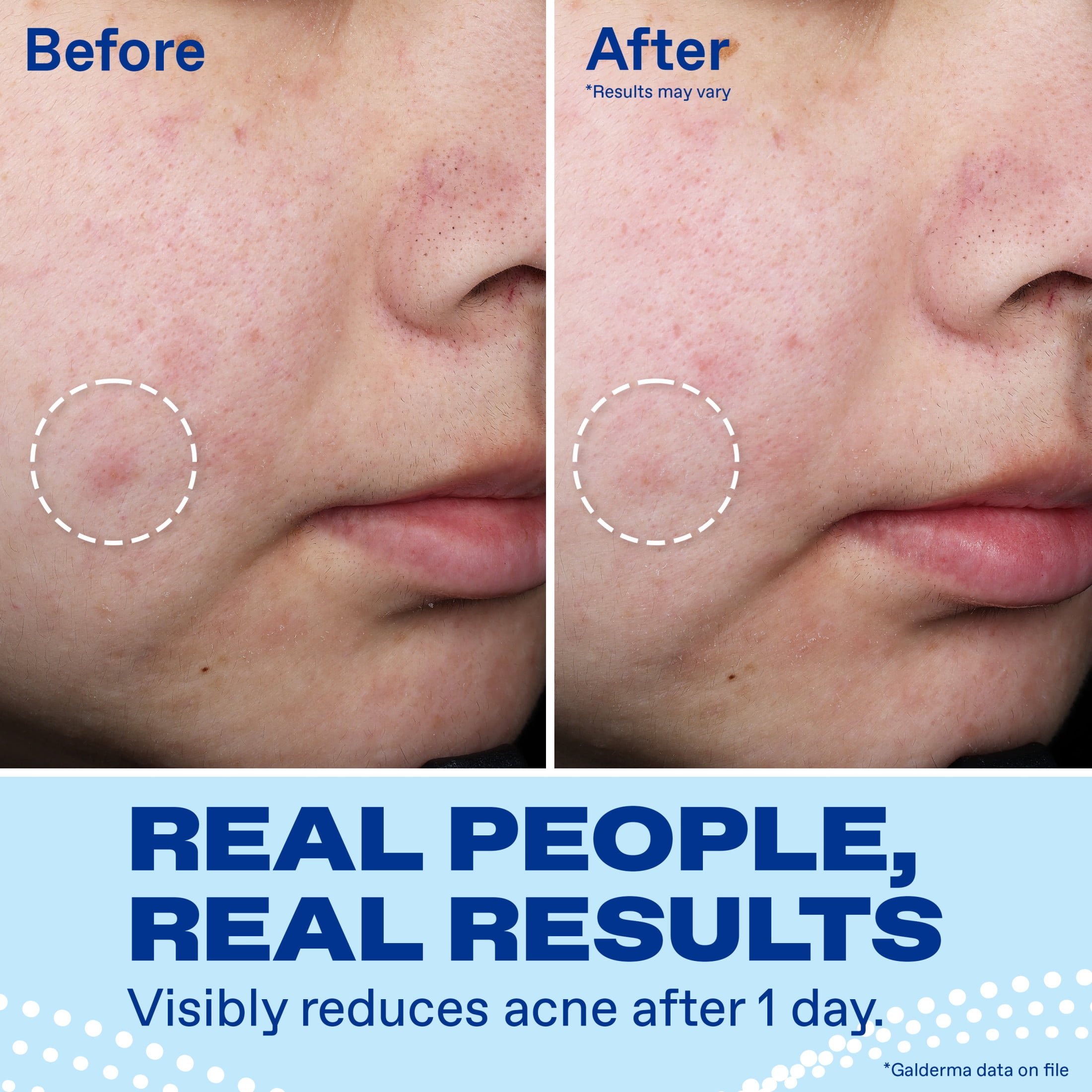 Differin Acne Spot Treatment with 10% Benzoyl Peroxide, Maximum Strength, Fast-Acting, Acne Treatment for Face & Body​, 1 oz