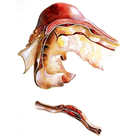 Two Sections of Aortic Aneurysm Poster Print by Science
