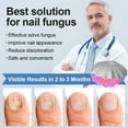thumbnail image 6 of Nail Care Finger Removal Against Toenail for Foot and Toenails with Solution, 6 of 8