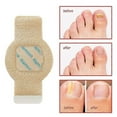 thumbnail image 2 of 1-5x Oenail Fungus Patch Waterproof Nail Repair Patches Nail Ingrown Correction Stickers, 2 of 5