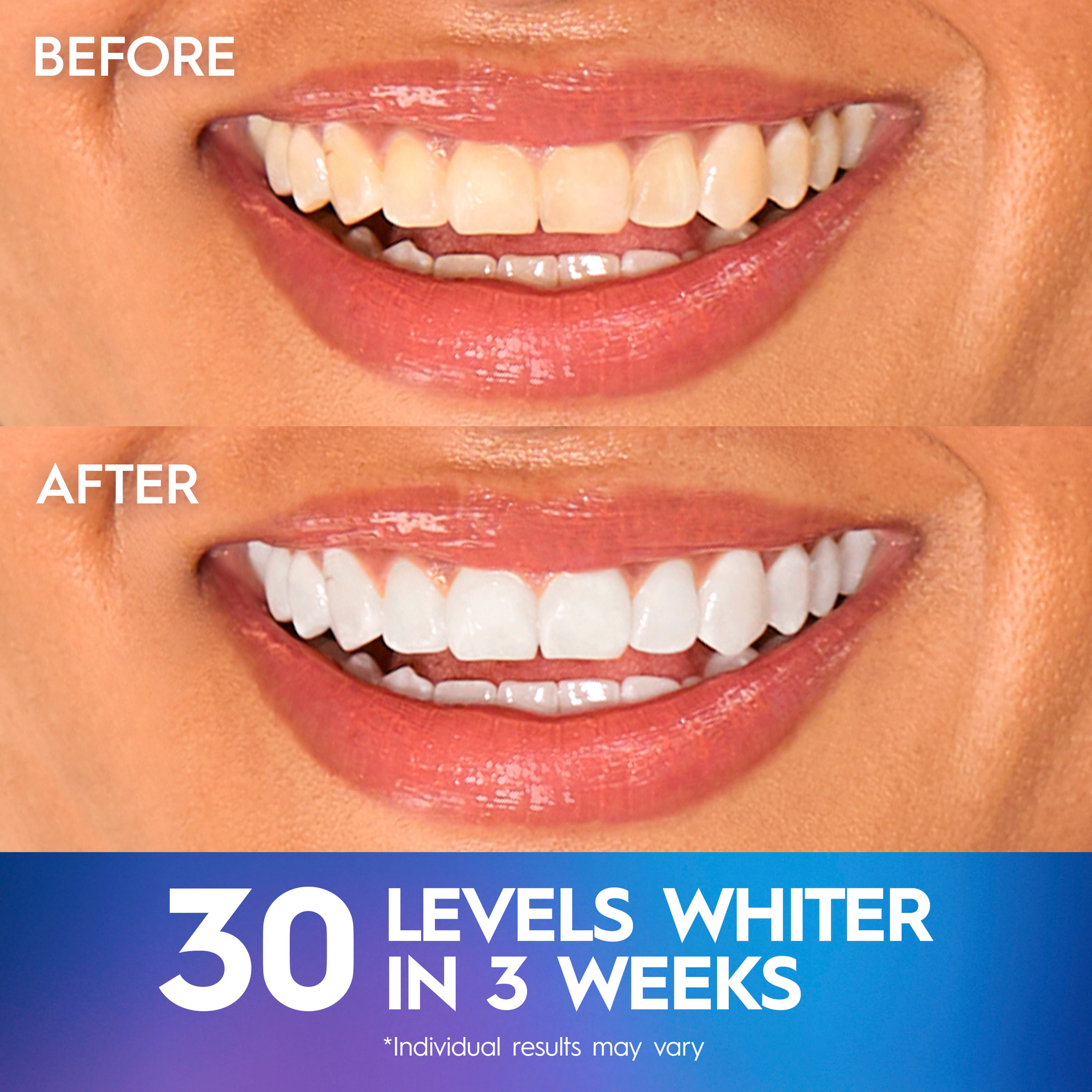 Crest 3DWhitestrips Professional Express Teeth Whitening Kit photo 4