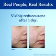 thumbnail image 2 of Differin Acne Spot Treatment with 10% Benzoyl Peroxide, Maximum Strength OTC Acne Spot Treatment, 1 oz ( 3 Pack ), 2 of 4