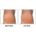 thumbnail image 2 of CALLUS TERMINATOR, 2 of 5