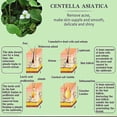thumbnail image 2 of Crema eficaz para eliminar el acné, tratamiento para el cuidado de manchas de cicatrices de acné, Control de aceite, reducción de poros, blanqueamiento, Gel hidratante antiacné para la cara Feliz Sencillez, 2 of 5