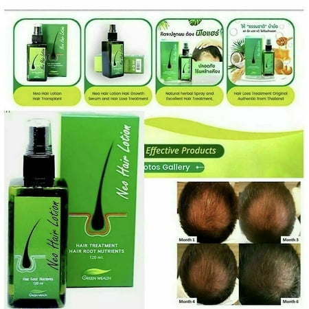 Neo Hair Regrowth Lotion Haircare / Hair Loss Oil / Baldness/ & 1 Derma Roller | Walmart Canada Neo Hair Regrowth Lotion Haircare / Hair Loss Oil / Baldness/ & 1 Derma Roller | Walmart Canada