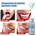 thumbnail image 3 of Temporary Tooth Repair Kit, Teeth Replacement Kit For Fix Filling The Missing Broken Tooth, 3 of 5