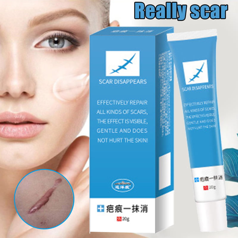 Scar Removal for Face Acne Scar Stretch Remover Cream Skin Cream 20G - Walmart.com