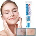 Acne Scars Remover for Face Pimples Acne Remover Scar Gel Pimple Marks