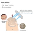 thumbnail image 3 of Nail Fungus Laser Nail Treatments Device Highly Effective Light Therapy For Fingernails And Toenails Onychomycosis Cure Machine, 3 of 4