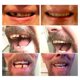 thumbnail image 5 of Kit de dientes temporales para reparación dental y reemplazo de dientes, 5 of 6