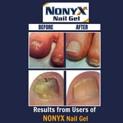 NonyX Nail Gel 4 Oz (Pack of 9)