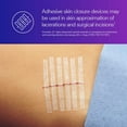 thumbnail image 6 of 3M Skin & Wound Closure Reinforced Strips R1546 - Sterile Adhesives for Wound & Cuts Healing with Minimal Scarring, Infection Prevention from Suture & Stample Removal - 1/4"x4" - Pack of 1, 6 of 8