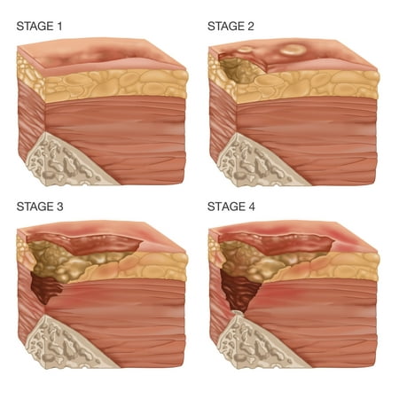 4 Stages of a Bedsore Illustration Rolled Canvas Art - Gwen ShockeyScience Source (24 x